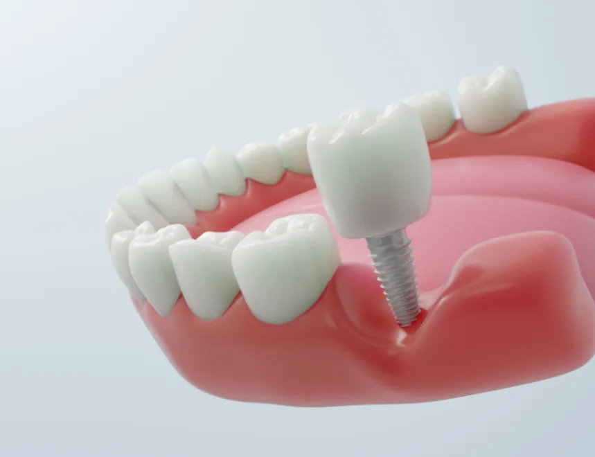 7 Early Signs You May Need a Dental Implant and Shouldn’t Ignore
